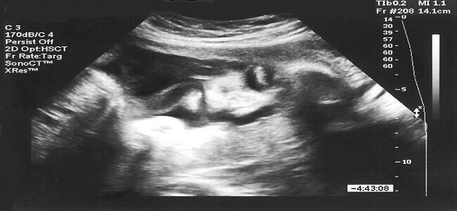 Drugi miesiąc ciąży