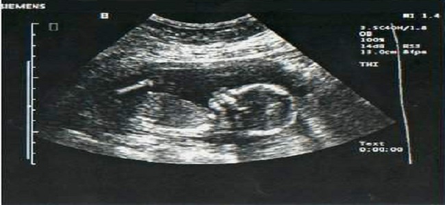Ciąża - kiedy pierwsze USG